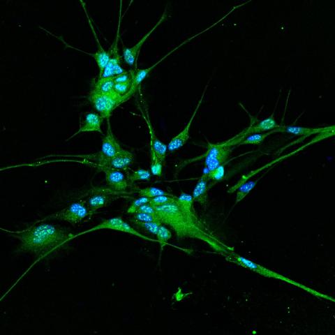 Colorazione (in verde) per il canale TMEM16B, un canale cloro attivato da calcio, su cellule di glioma derivate da paziente.